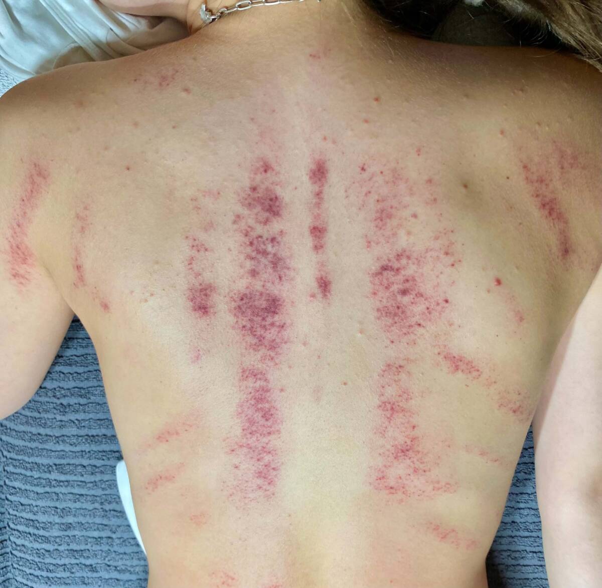 Gua Sha Diana Fischer